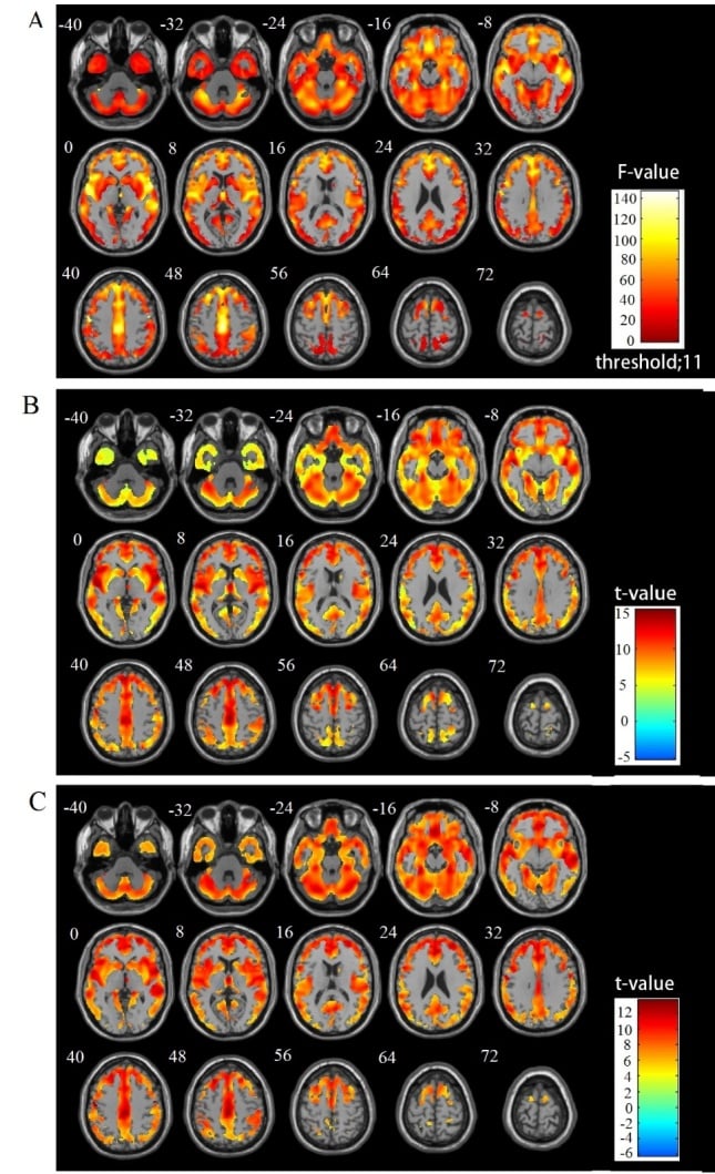 Age-Related Gray and White Matter Changes in Normal Adult Brains ...