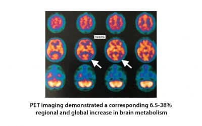 Hyperbaric oxygen therapy for Alzheimer’s dementia with positron emission tomography imaging: a case report.