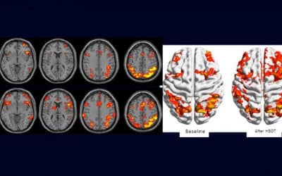 Israeli Study of IDF veterans shows oxygen therapy reduces PTSD symptoms