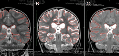 Oxygen and hyperbaric oxygen therapy reverses brain damage in drowned toddler