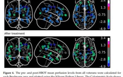 A Case Series of 39 United States Veterans with Mild Traumatic Brain Injury Treated with Hyperbaric Oxygen Therapy